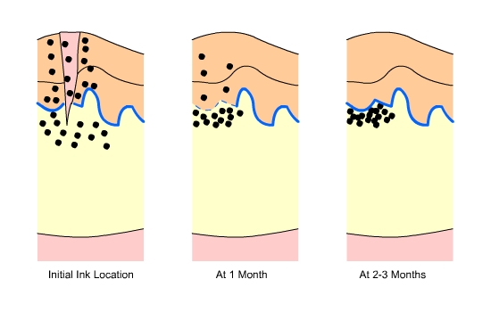 Fig.3 Ink Location: soon after the tattoo is received, one month after, 